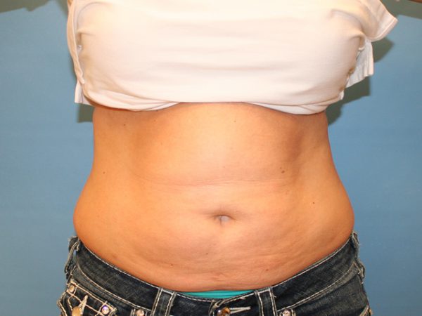 Before CoolSculpting