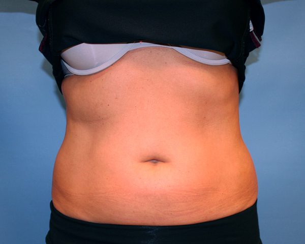 After CoolSculpting