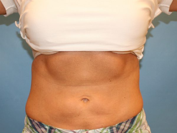 After CoolSculpting