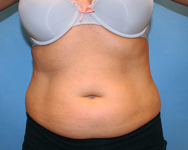 Before CoolSculpting