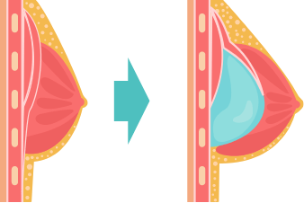 Diagram of silicone implant within a breast structure