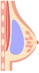 Diagram of a saline implant within a breast structure