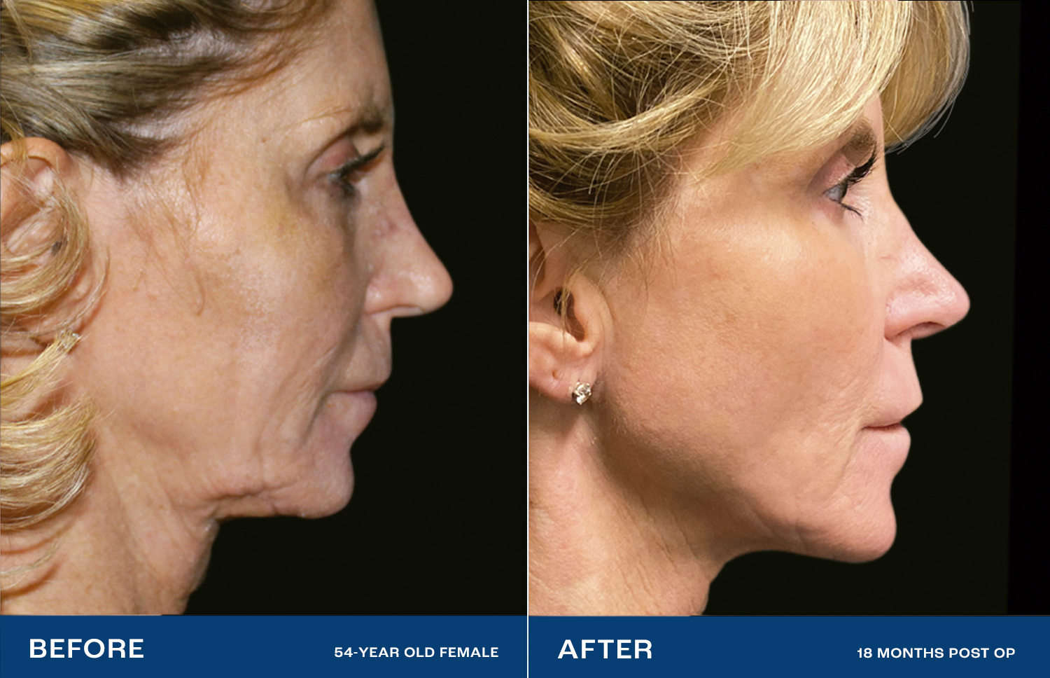 Renuvion Treatment in Vero Beach, FL