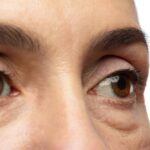 Can Blepharoplasty Get Rid of Tired Eyes?